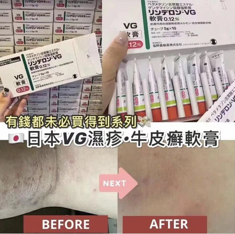 日本VG荨麻湿疹膏